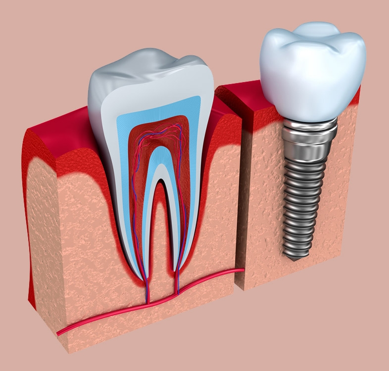 بهترین مرکز ایمپلنت در تهران