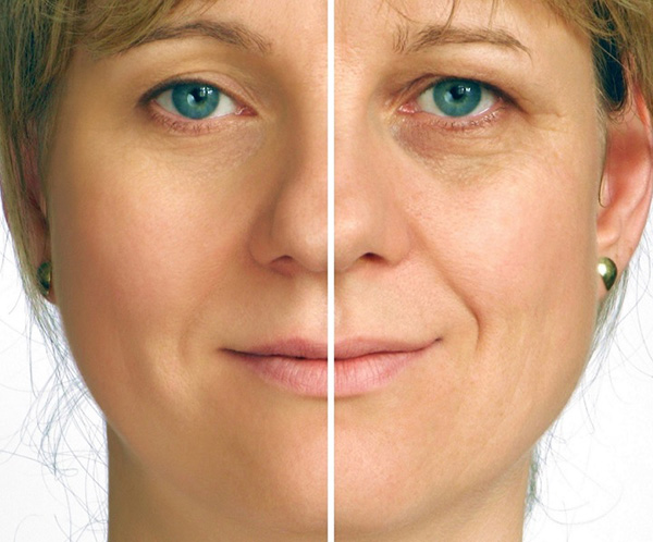 لیفت صورت و گردن - ( Face Lift ( Facial Rejuvenation