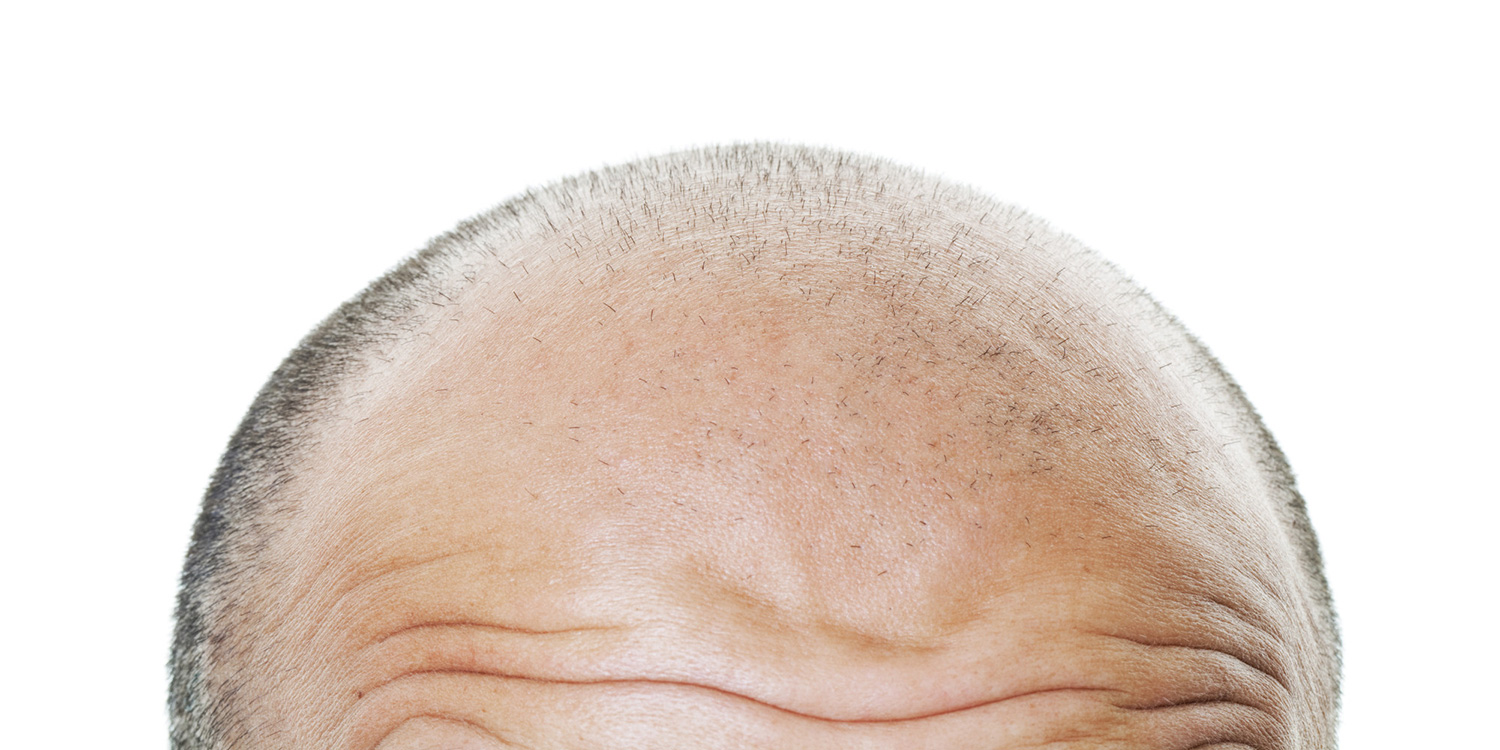 severe-hair-loss