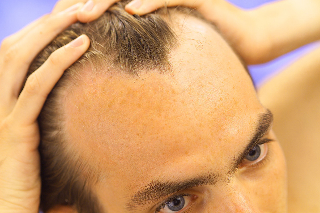 hair-loss-treatment-men