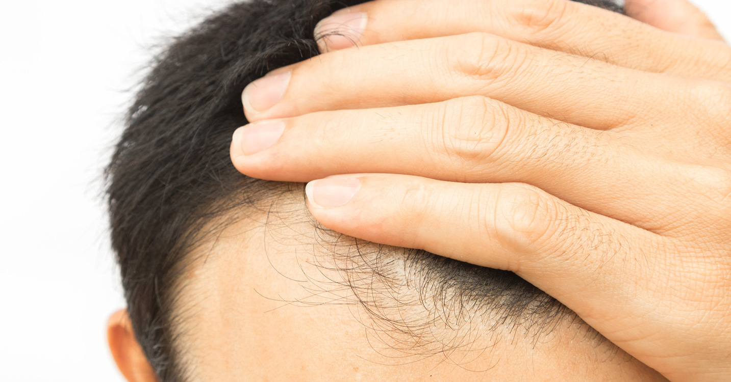 hair-loss-treatment-men
