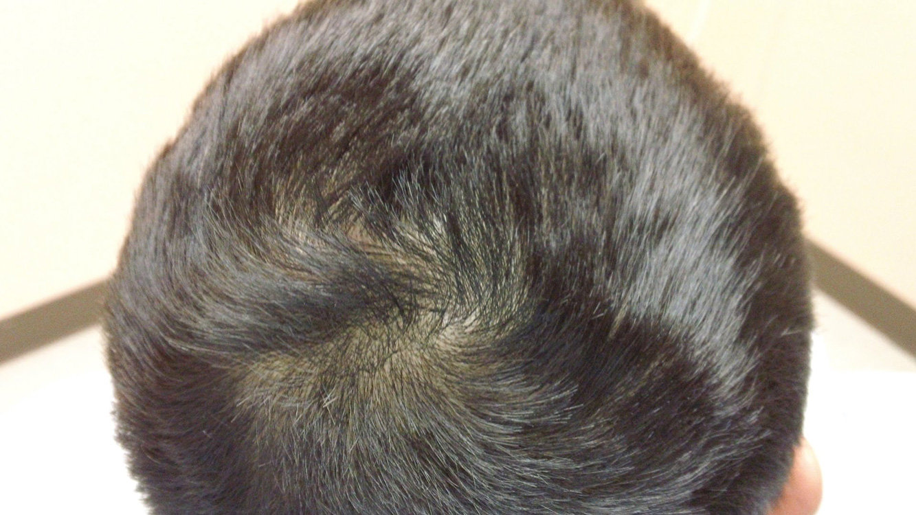 گامی بزرگ در درمان ریزش مو با استفاده از مزوتراپی و پی آر پی