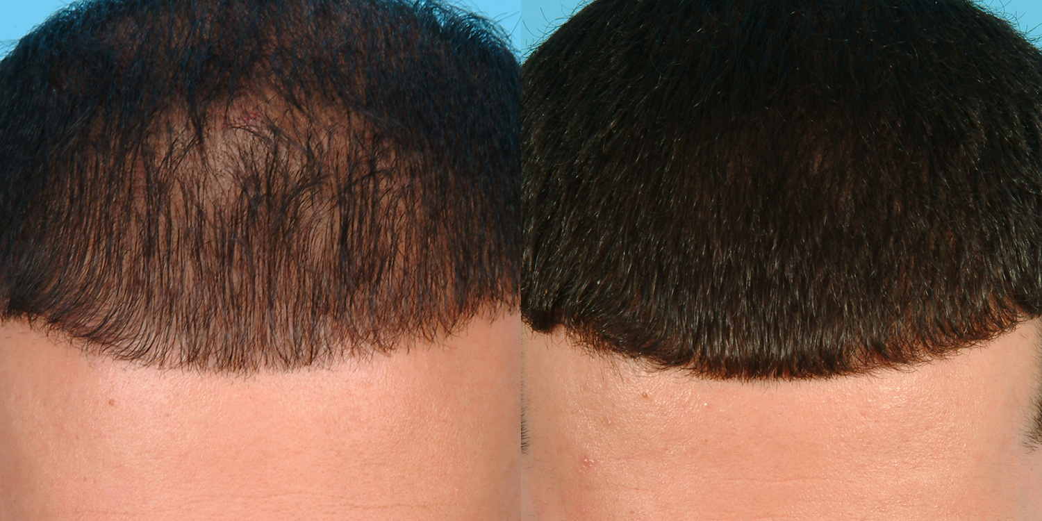 گامی بزرگ در درمان ریزش مو با استفاده از مزوتراپی و پی آر پی