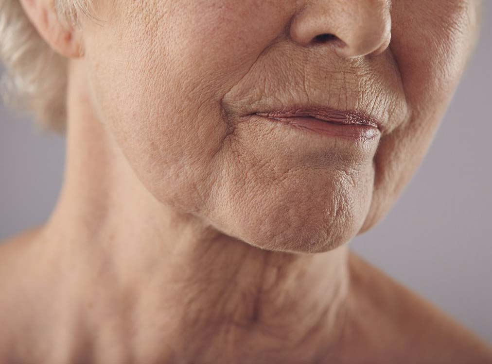 درمان شلی، افتادگی، چین و چروک گردن