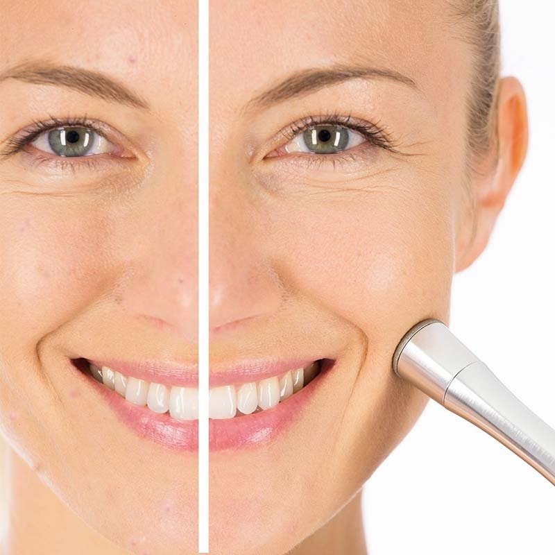 کرم و ژل مناسب پس از لیزر، پیلینگ و میکرودرم ابریژن