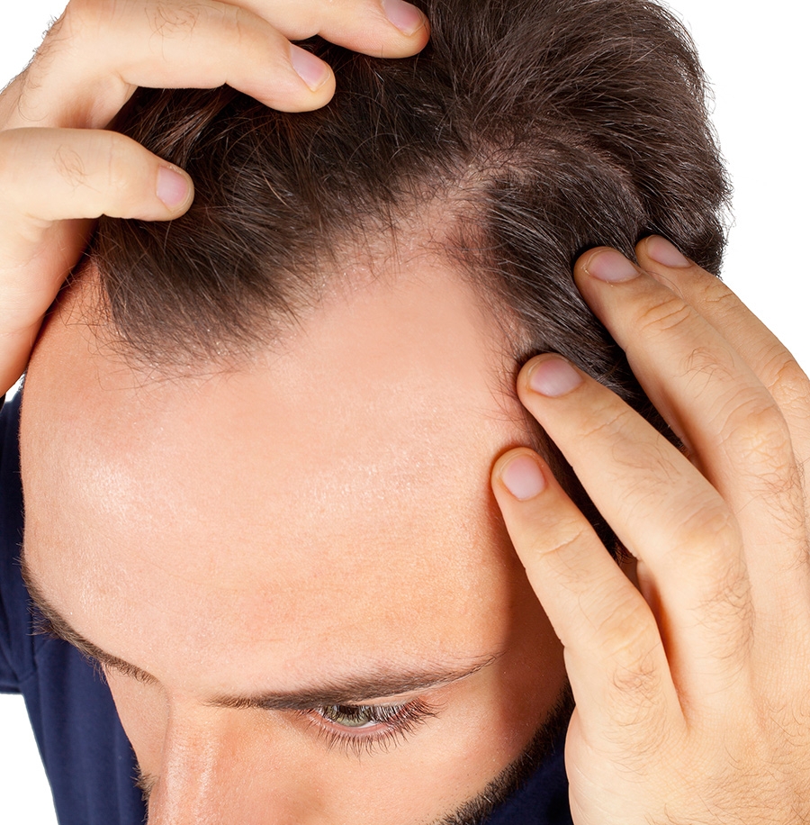 ریزش مو ارثی