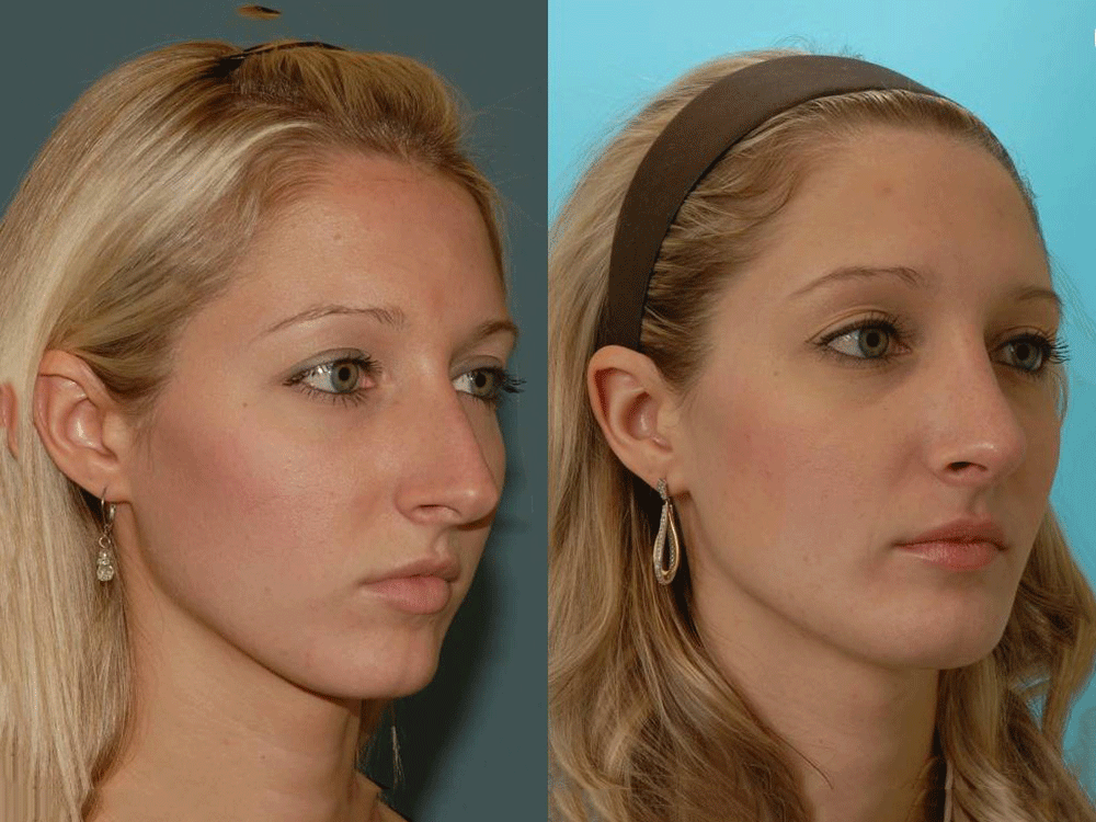 جراحی ‌زیبایی بینی‌ ( رینوپلاستی ) - Primary Rhinoplasty