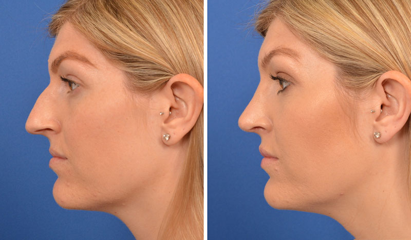 primary-rhinoplasty