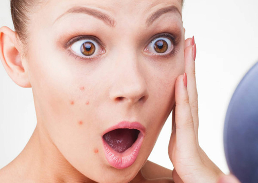 treat-face-acne-simply