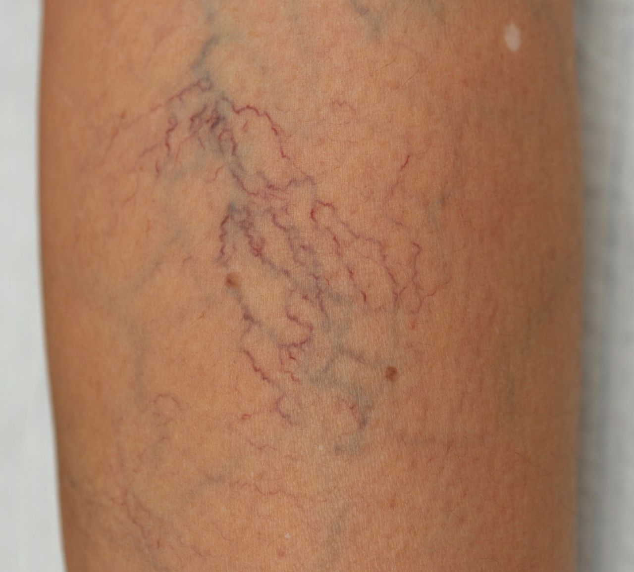 درمان واریس پا در سریع ترین زمان