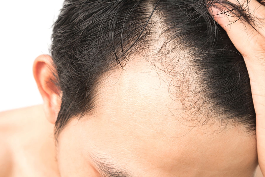 کاشت مو بدون جراحی و تراشیدن موی سر