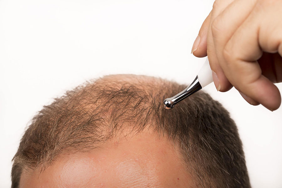 hair-transplantation-without-surgery