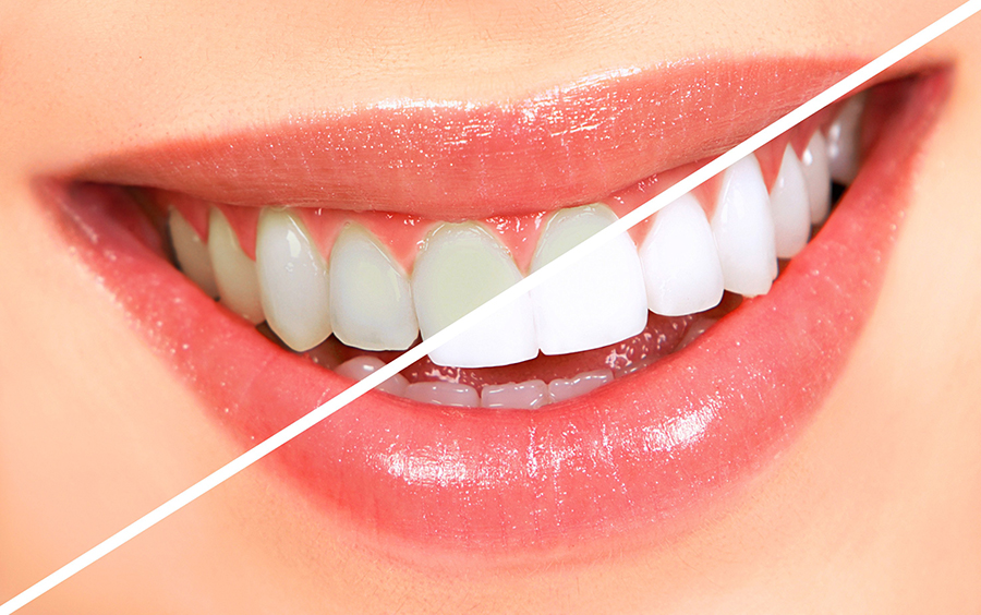 بلیچینگ دندان چیست؟ سفید کننده قوی دندان ها