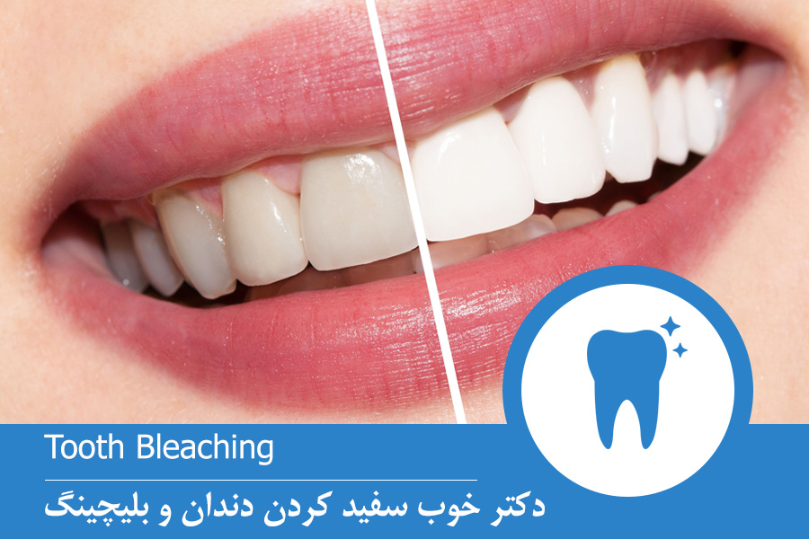 دکتر خوب سفید کردن دندان و بلیچینگ