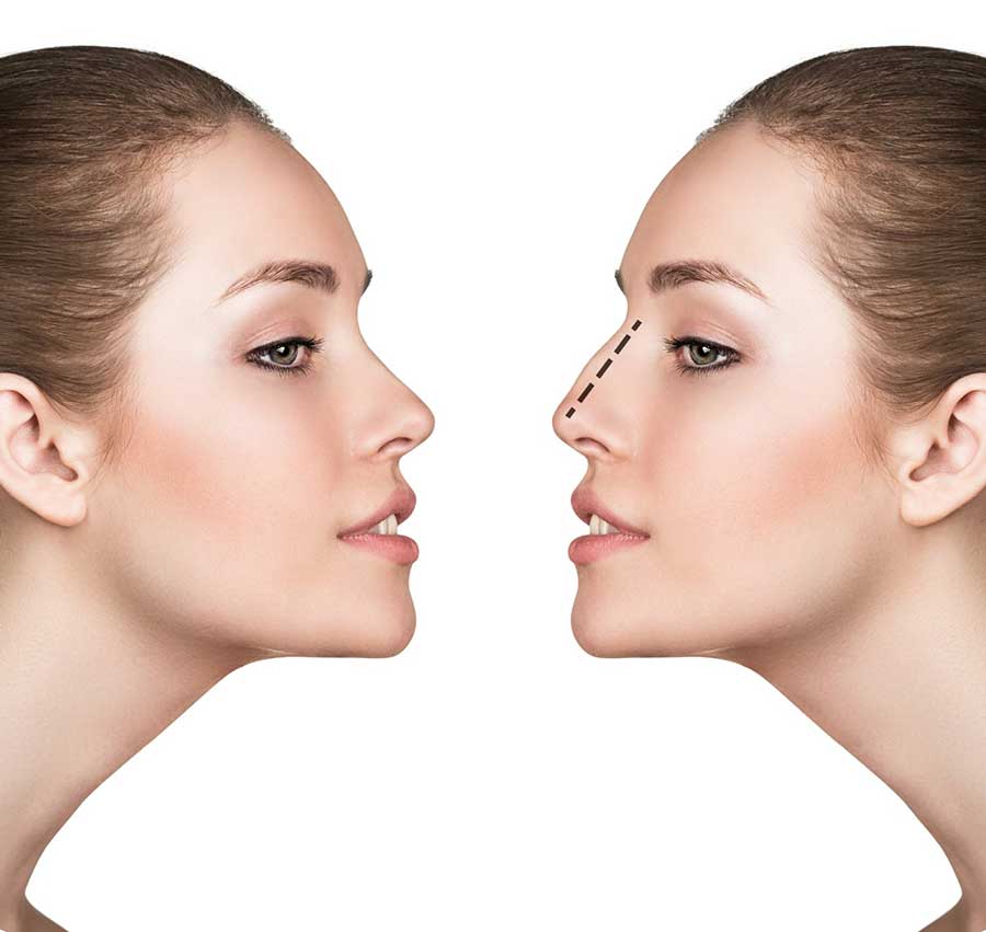 rhinoplasty-pros-and-cons