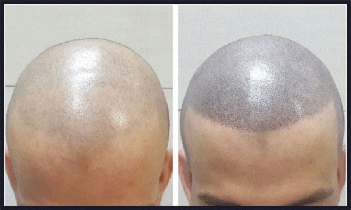آموزش میکرواسکالپ