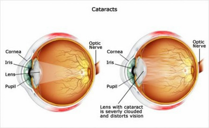 علت نابینایی و انواع نابینایی چشم