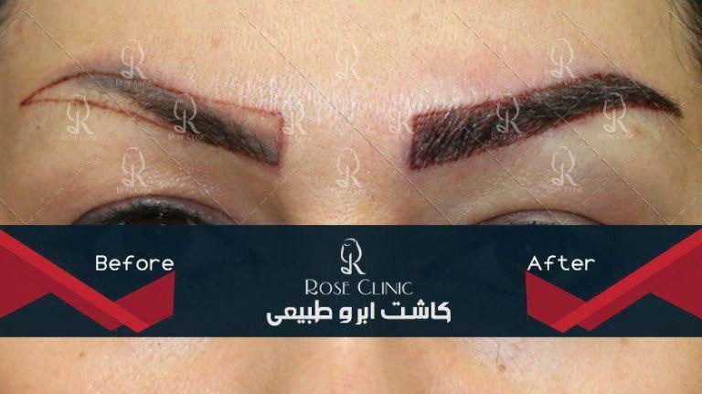 بعد از کاشت ابرو چه باید کرد؟