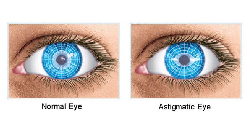 eye-astigmatism