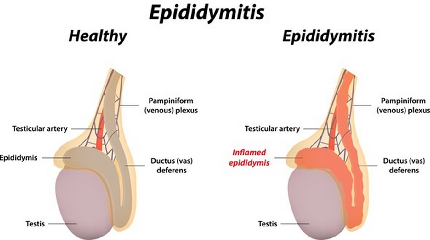 Epididymitis اپیدیدیمیت چیست (علل، علائم، پیشگیری و درمان)