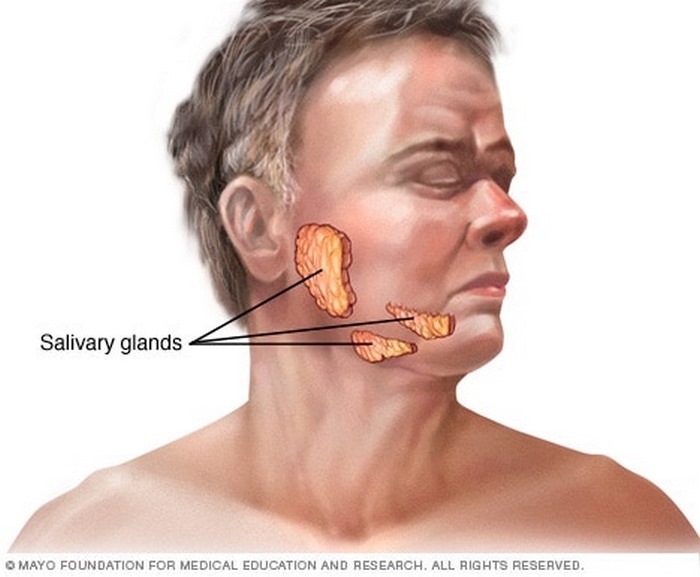 اوریون چیست (علل، علائم، پیشگیری و درمان) mumps اوریون چیست (علل، علائم، پیشگیری و درمان) mumps