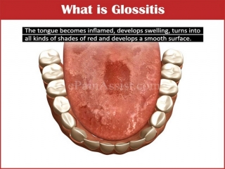 التهاب‌ زبان‌ چیست (علل، علائم، پیشگیری و درمان) Glossitis