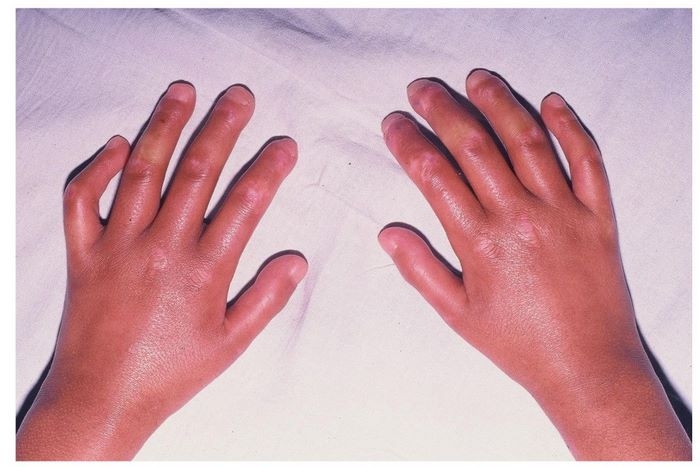 اسکلرودرمی چیست (علل، علائم، پیشگیری و درمان) scleroderma