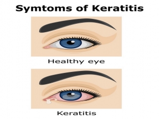 التهاب‌ قرنیه‌ چیست (علل، علائم، پیشگیری و درمان) keratitis