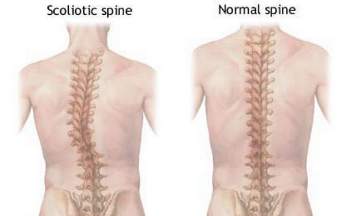 اسکولیوز چیست (علل، علائم، پیشگیری و درمان) scoliosis