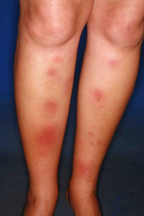 اریتم‌ گرهی‌ چیست (علل، علائم، پیشگیری و درمان) erythema nodosum