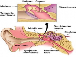otosclerosis اتواسکلروز چیست (علل، علائم، پیشگیری و درمان)