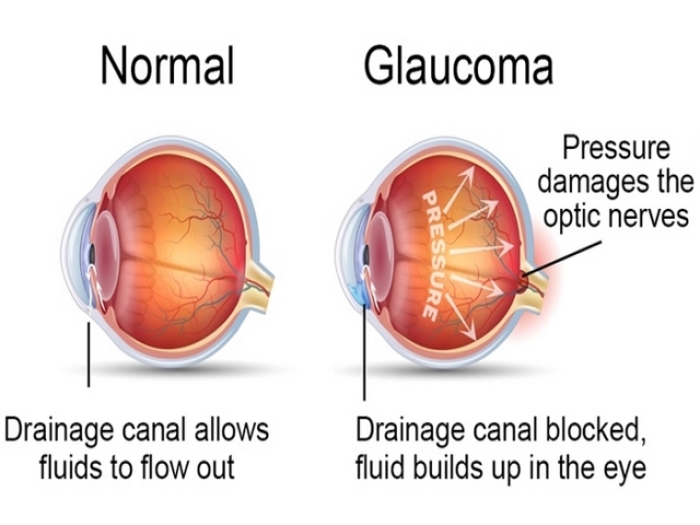 آب سیاه چشم چیست (علل، علائم، پیشگیری و درمان) glaucoma آب سیاه چشم چیست (علل، علائم، پیشگیری و درمان) glaucoma