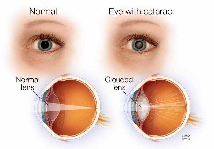 آب مروارید چیست (علل، علائم، پیشگیری و درمان) cataract
