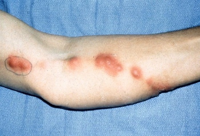 اسپوروتریکوز چیست (علل، علائم، پیشگیری و درمان) sporotrichosis
