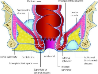 آبسه‌ آنورکتال‌ چیست (علل، علائم، پیشگیری و درمان) anorectal abscess