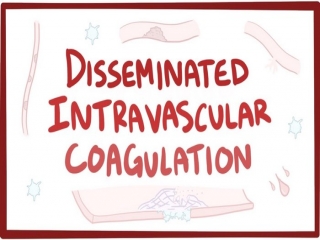 انعقاد داخل‌ عروق‌ منتشر چیست (علل، علائم، پیشگیری و درمان) disseminated intravascular coagulation