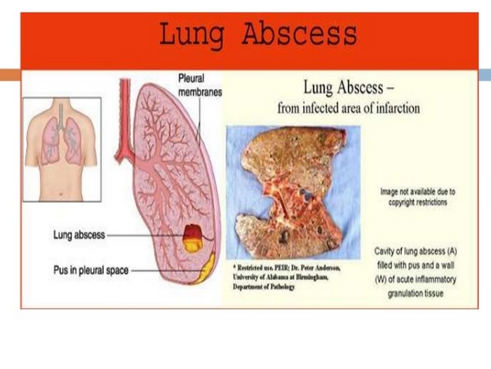 آبسه‌ ریه‌ چیست (علل، علائم، پیشگیری و درمان) lung abscess