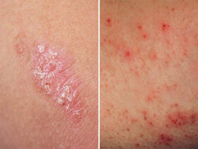 اگزما چیست (علل، علائم، پیشگیری و درمان) eczema اگزما چیست (علل، علائم، پیشگیری و درمان) eczema