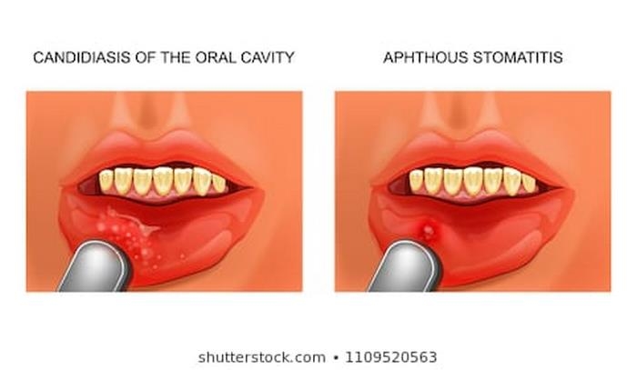 استوماتیت‌ چیست (علل، علائم، پیشگیری و درمان) stomatitis