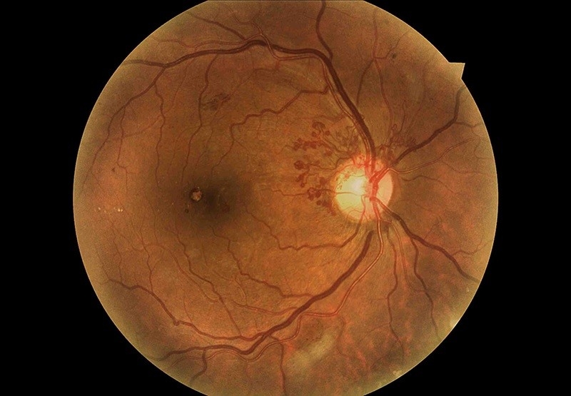 درمان ورم شبکیه چشم توسط فوق تخصص شبکیه