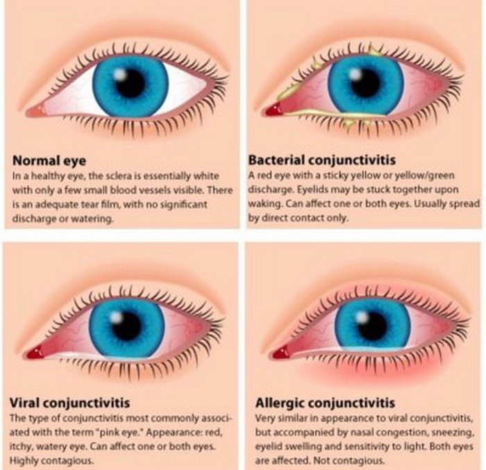 التهاب‌ ملتحمه‌ چیست (علل، علائم، پیشگیری و درمان) conjunctivitis