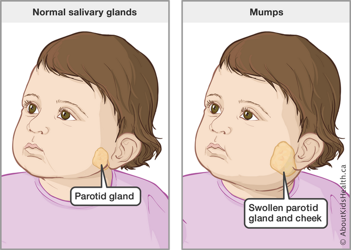mumps