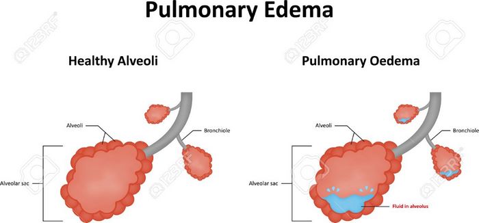 ادم‌ ریه‌ چیست (علل، علائم، پیشگیری و درمان) pulmonary edema