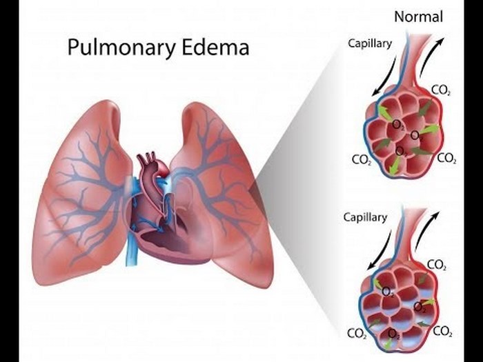 pulmonary-edema