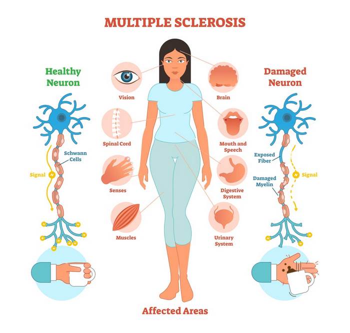 اسکلروز متعدد چیست (علل، علائم، پیشگیری و درمان) Multiple sclerosis