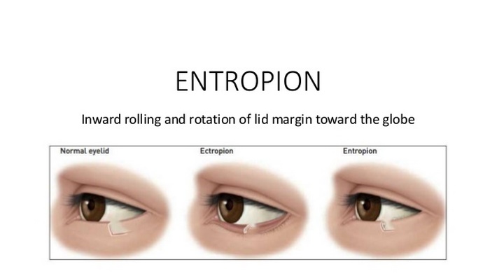 انتروپیون‌ چیست (علل، علائم، پیشگیری و درمان) entropion