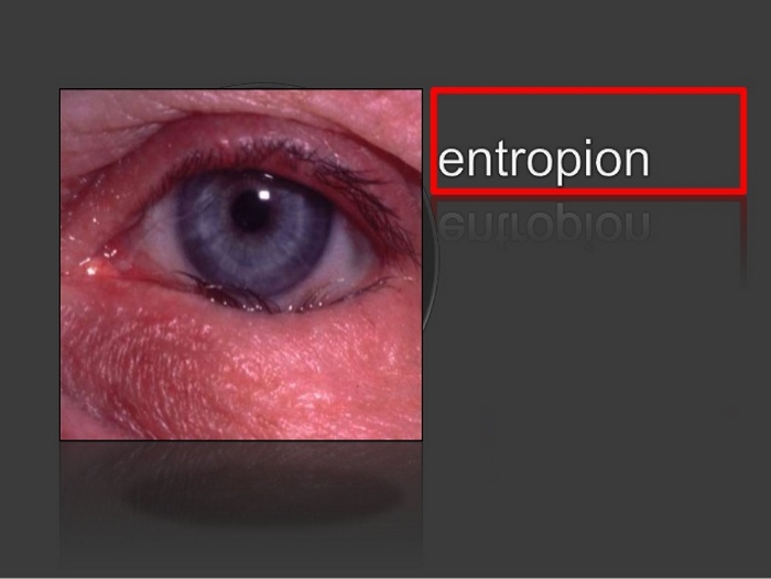 entropion