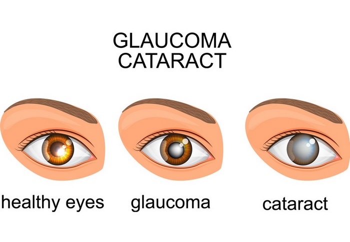 آب‌ سیاه‌ چشم‌ چیست (علل، علائم، پیشگیری و درمان) glaucoma
