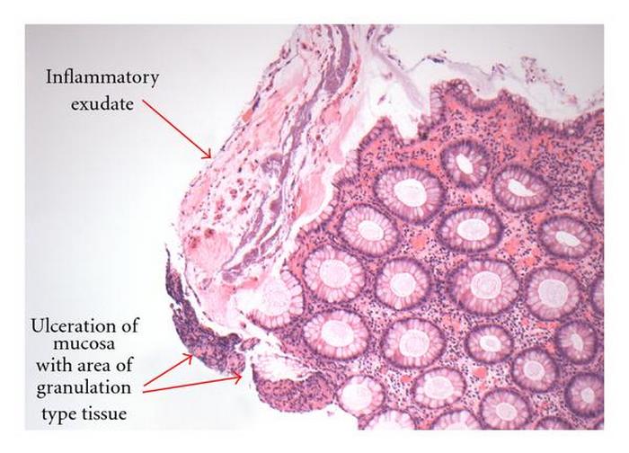 pseudomembranous-enterocolitis