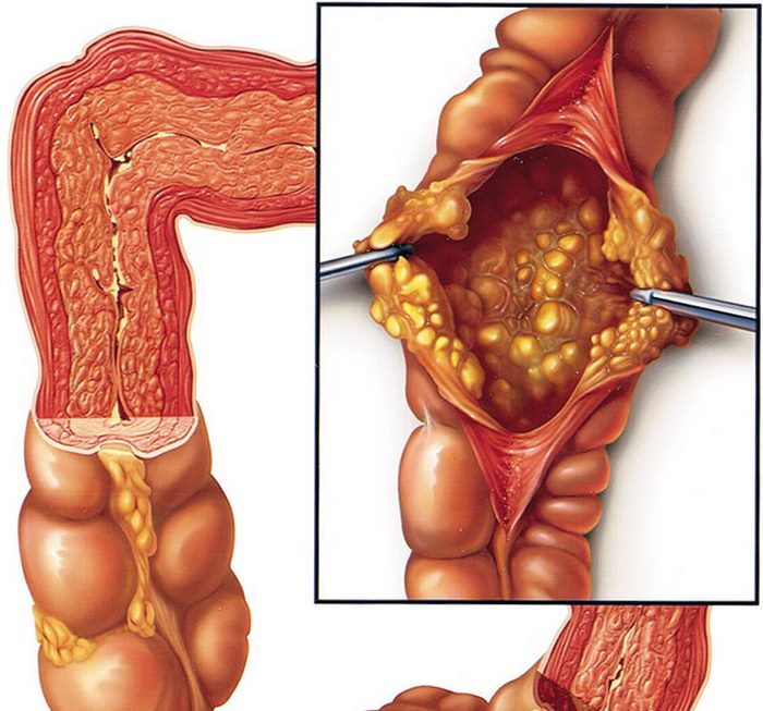 انتروکولیت‌ با غشای‌ کاذب‌ چیست (علل، علائم، پیشگیری و درمان) pseudomembranous enterocolitis